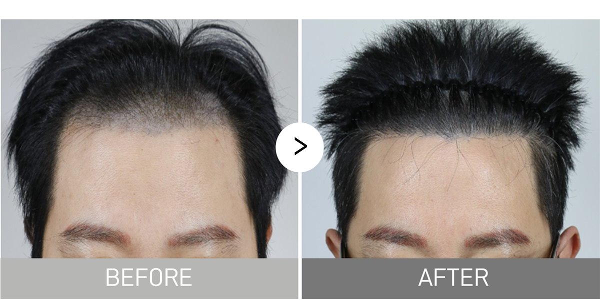 3,000 grafts to cover scalp micropigmentation