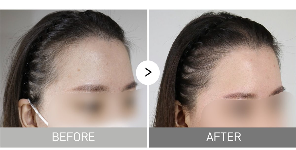 Women's hairline, 1,500 grafts