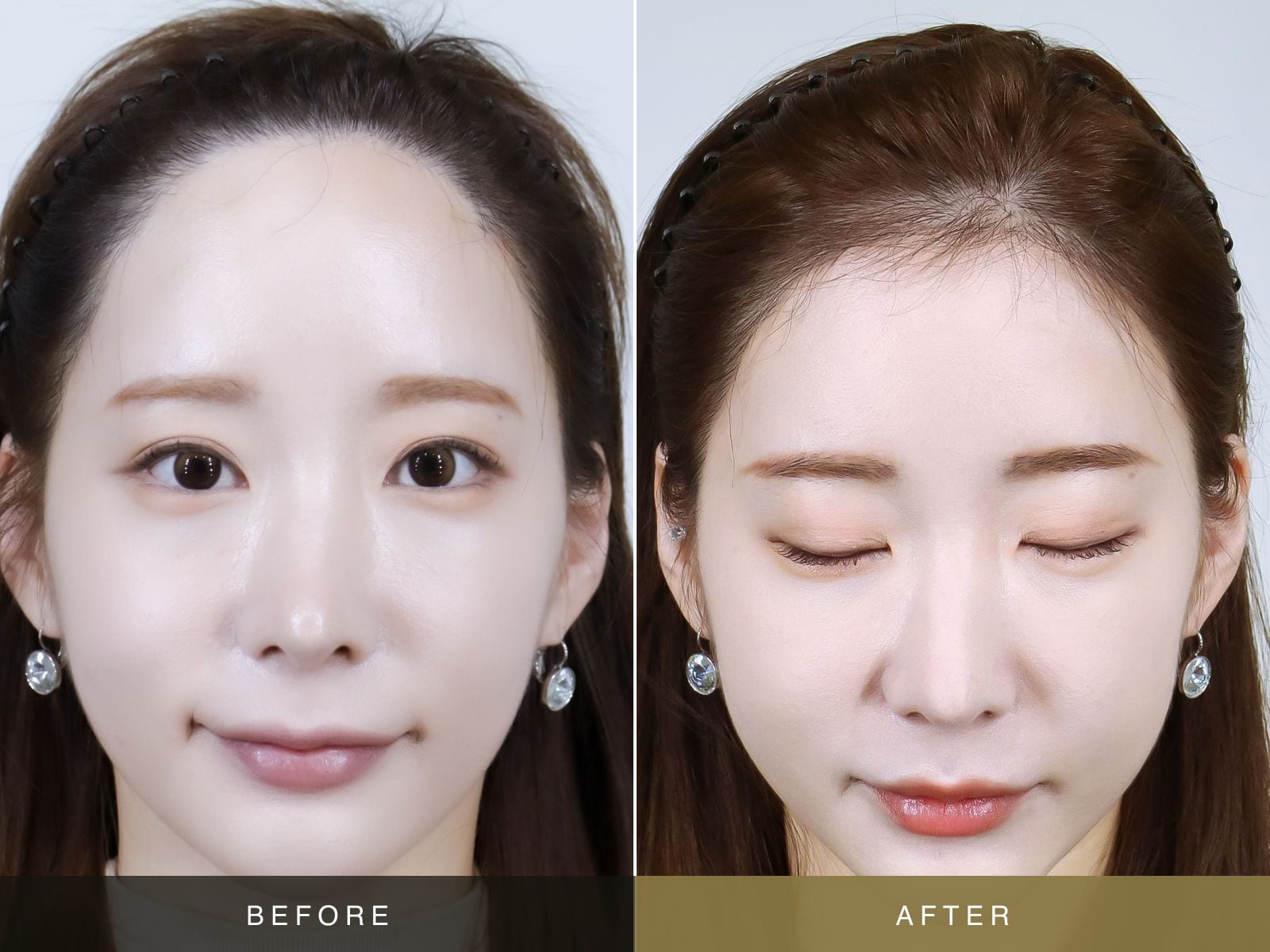 모우림의원 리얼모델의 여성 헤어라인 수술 전후 정면 사진