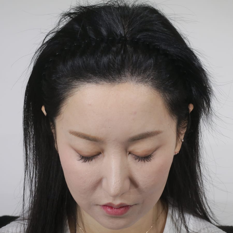 규비 수술 후