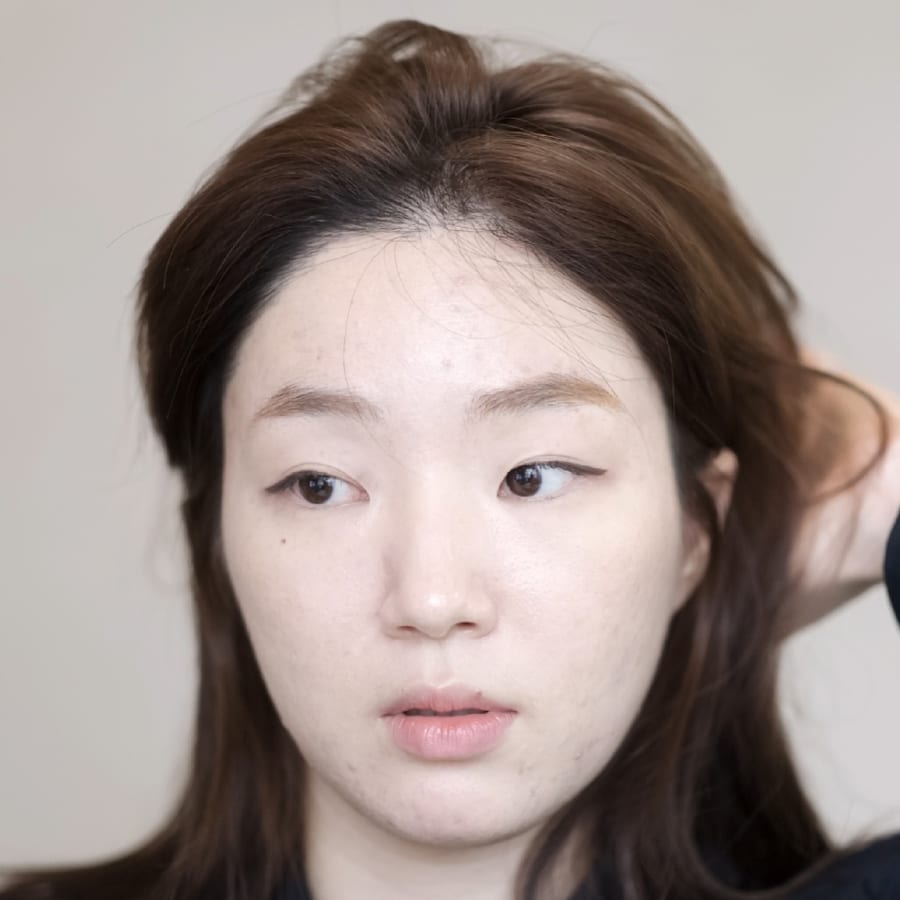 지수 수술 후