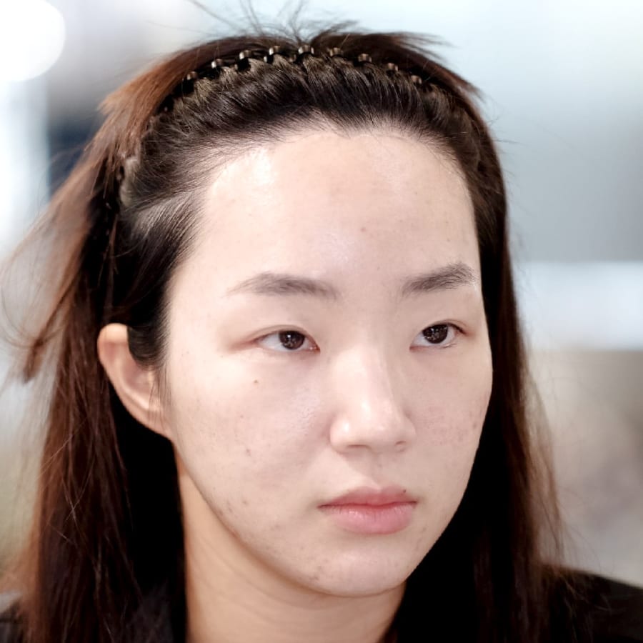 지수 수술 전