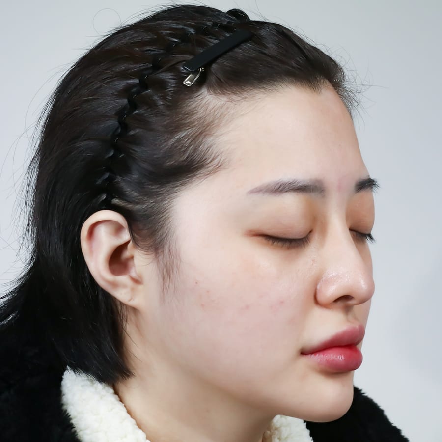 설화 수술 전