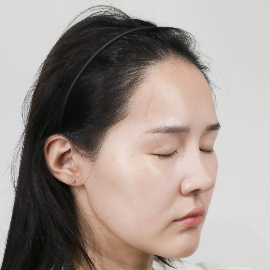 세라 수술 후