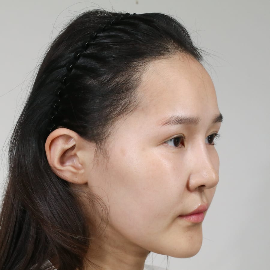 세라 수술 전