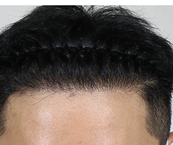AFTER แนวผมชาย 2,000 กราฟต์ · หลังผ่าตัด 6 เดือน