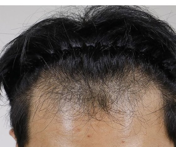BEFORE แนวผมชาย