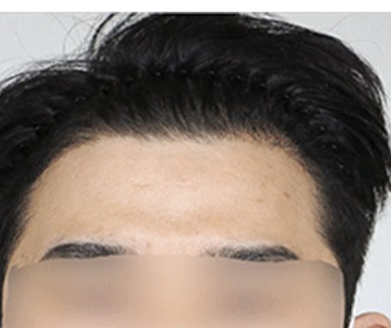 AFTER แนวผมชาย 3,000 กราฟต์ · หลังผ่าตัด 6 เดือน