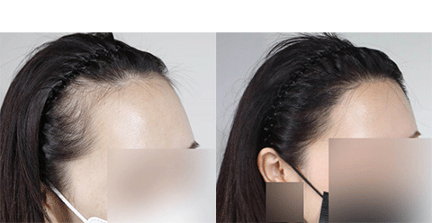 남성 헤어라인 교정