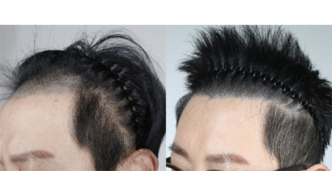 남성 헤어라인 교정