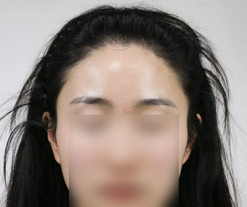 AFTER 여성 · 비절개 1,000모 · 헤어라인