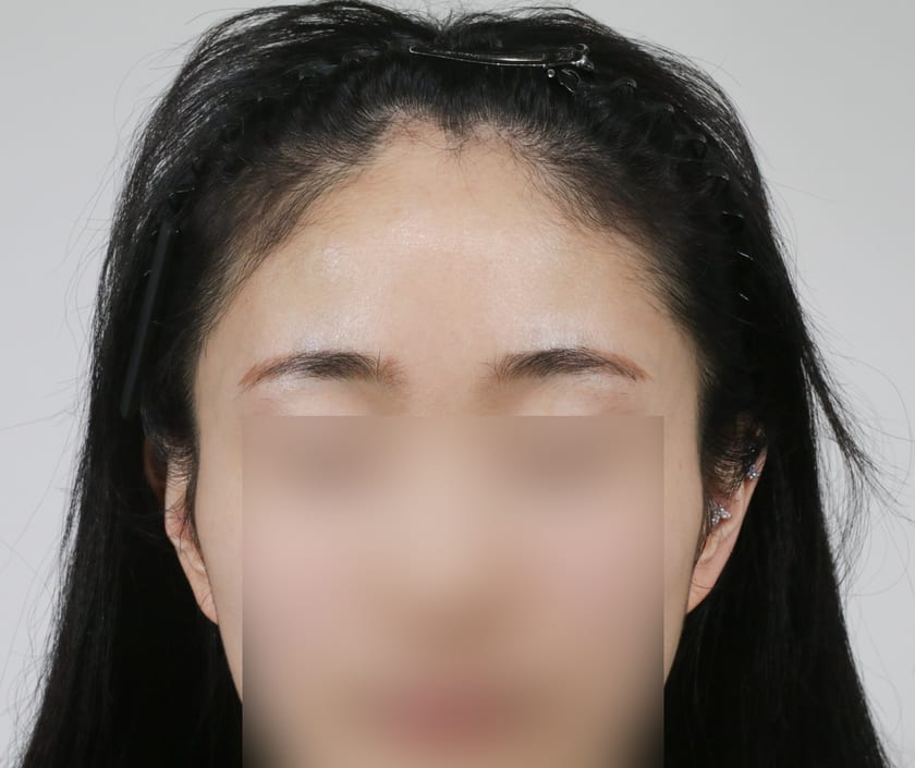 BEFORE 여성 · 비절개 1,000모 · 헤어라인