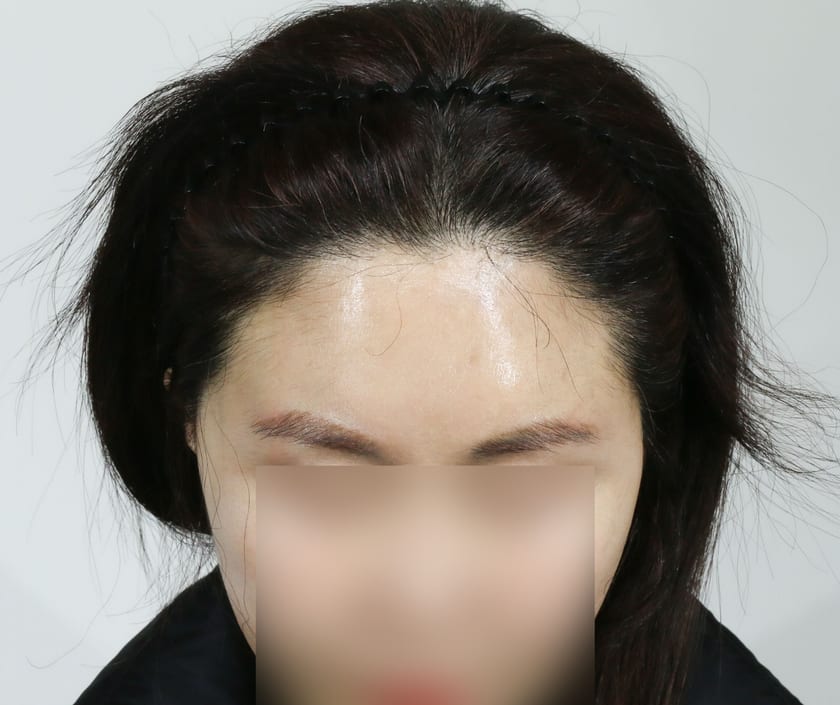 AFTER 여성 · 절개 2,300모 · 헤어라인 · 관자놀이 · 구레나룻