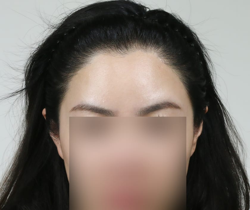 AFTER 여성 · 비절개 박스컷 2,800모 · 헤어라인