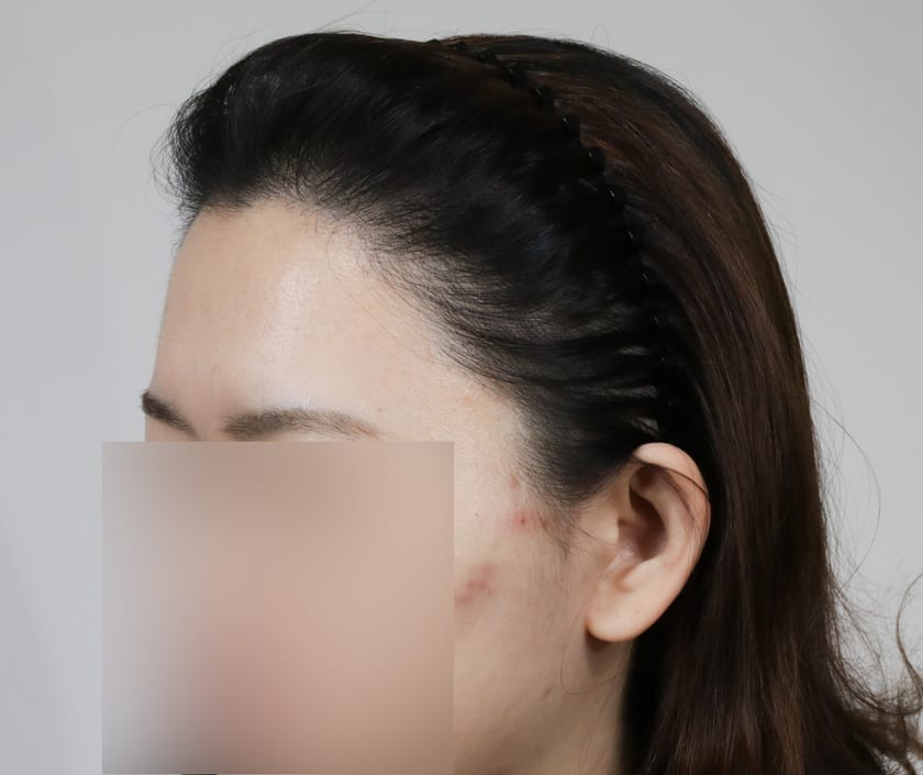 AFTER 여성 · 절개 3,000모 · 헤어라인 · 관자놀이