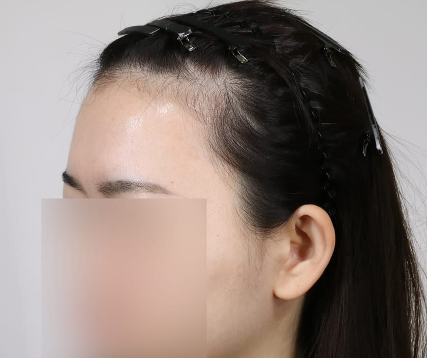 BEFORE 여성 · 절개 3,000모 · 헤어라인 · 관자놀이