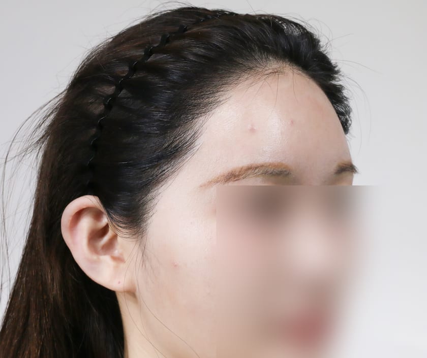 AFTER 여성 · 절개 3,500모 · 헤어라인 · 관자놀이 · 구레나룻