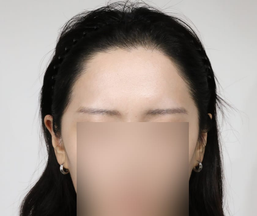 AFTER 여성 · 절개 3,500모 · 헤어라인 · 관자놀이 · 구레나룻