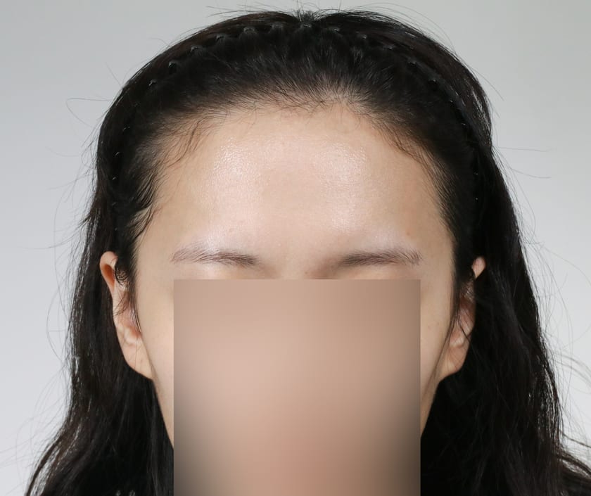 BEFORE 여성 · 절개 3,500모 · 헤어라인 · 관자놀이 · 구레나룻