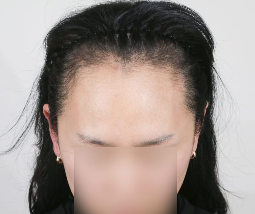 BEFORE 여성 · 절개 4,200모 · 헤어라인 · 관자놀이