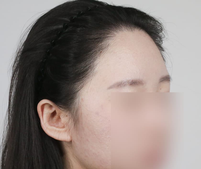 AFTER 여성 위로 솟은 헤어라인 교정
