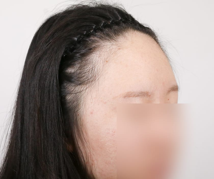 BEFORE 여성 위로 솟은 헤어라인 교정