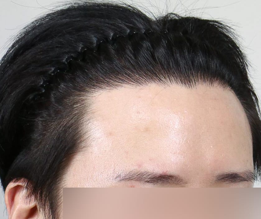 AFTER 남성 · 절개 1,700모 · 헤어라인