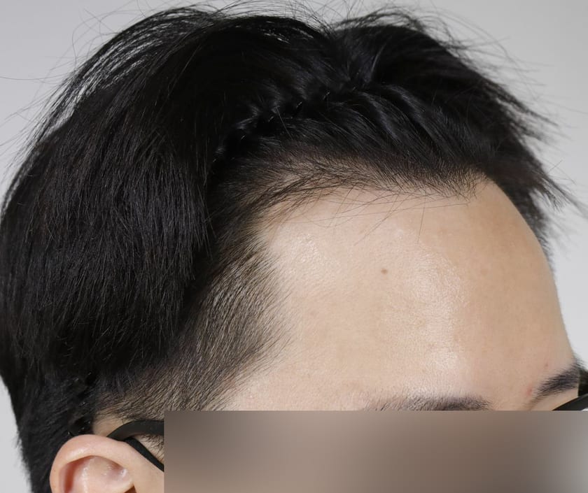 BEFORE 남성 · 절개 1,700모 · 헤어라인