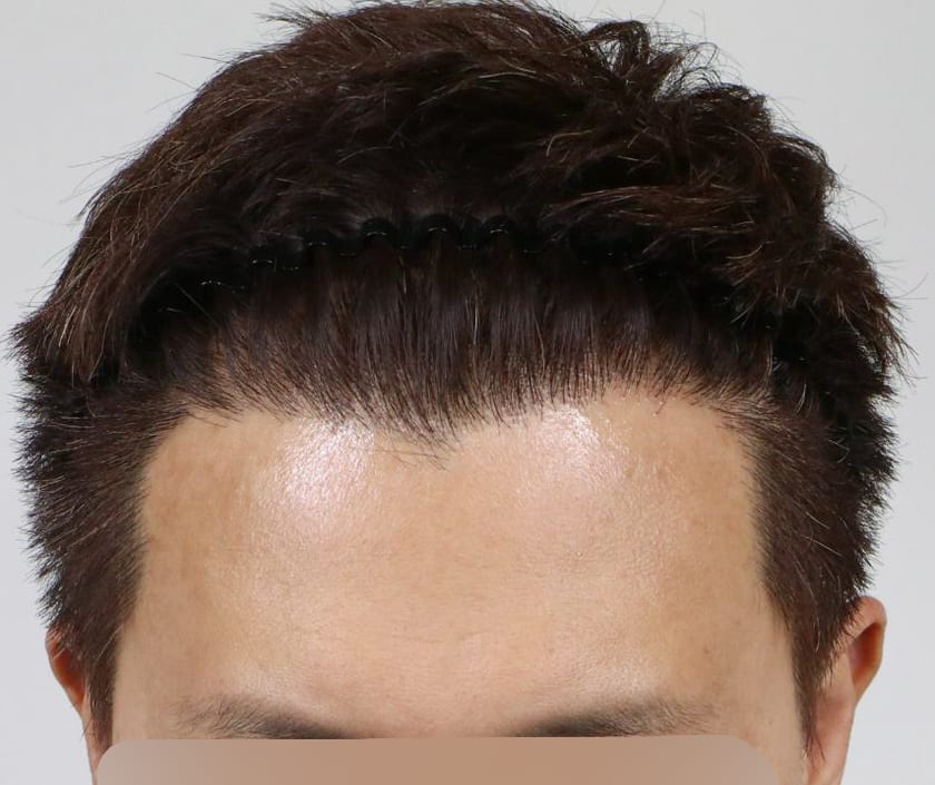 AFTER 남성 · 절개 2,000모 · 헤어라인