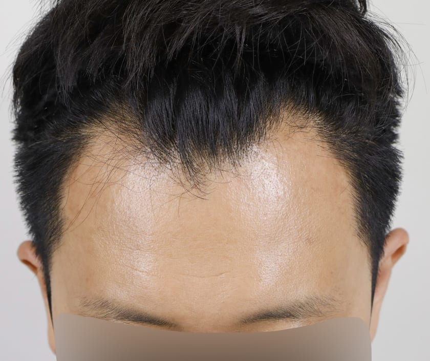 BEFORE 남성 · 절개 2,000모 · 헤어라인