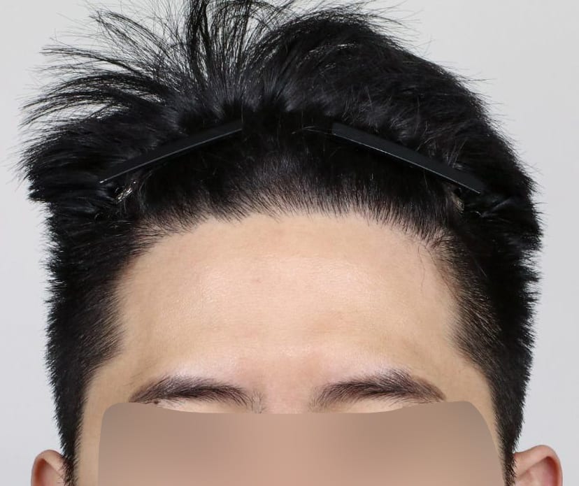 AFTER 남성 · 절개 2,000모 · 헤어라인