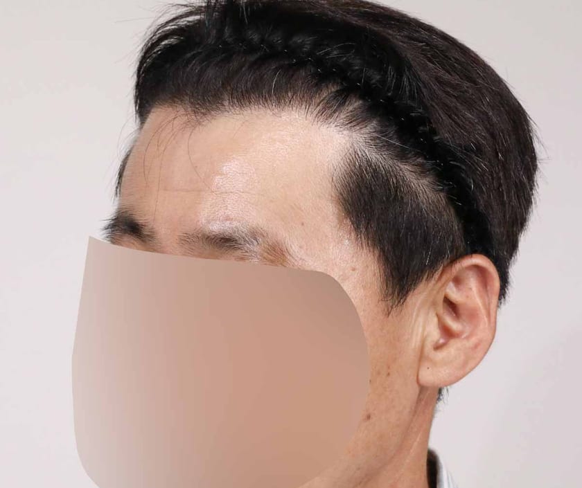 AFTER 남성 · 절개 2,000모 · 헤어라인