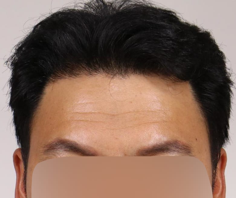 AFTER 남성 · 절개 2,200모 · 헤어라인