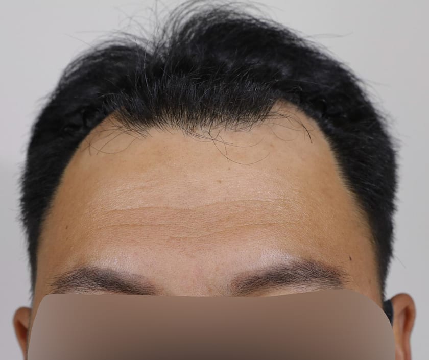 BEFORE 남성 · 절개 2,200모 · 헤어라인