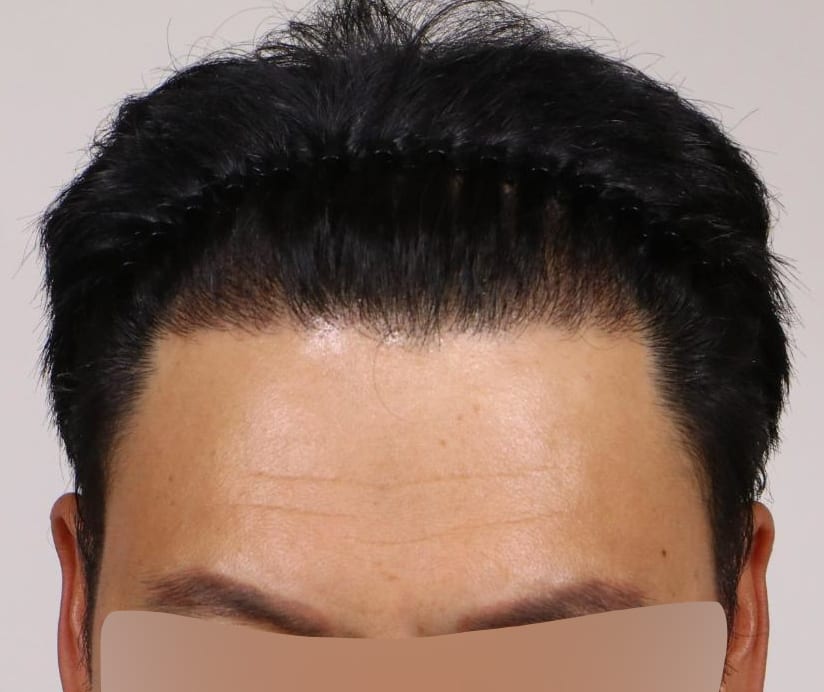 AFTER 남성 · 절개 2,200모 · 헤어라인