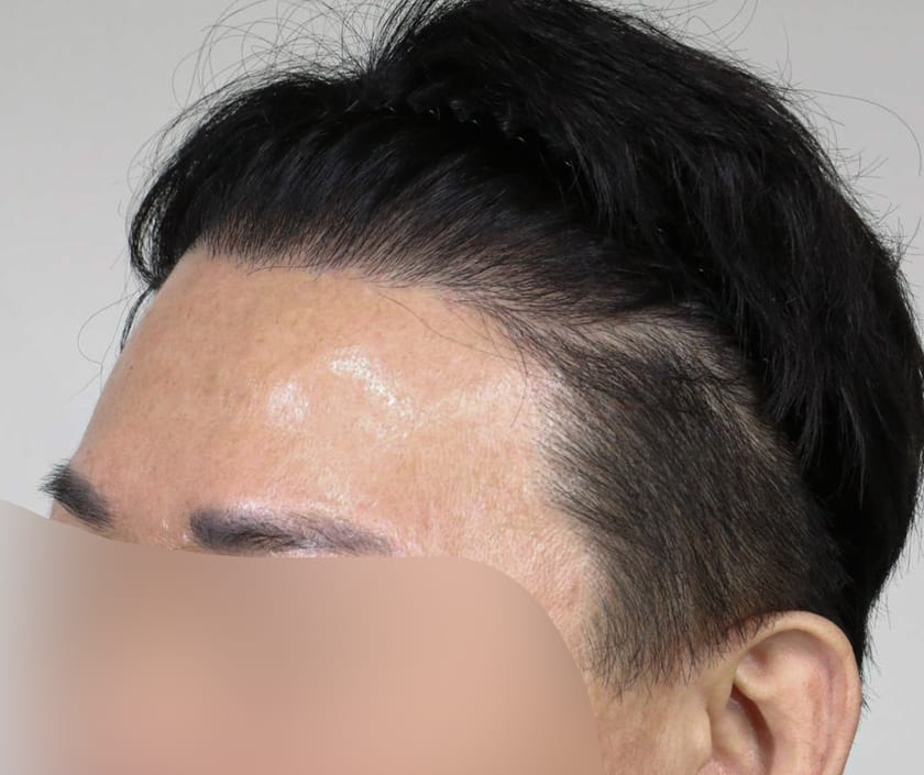 AFTER 남성 · 절개 2,300모 · 헤어라인