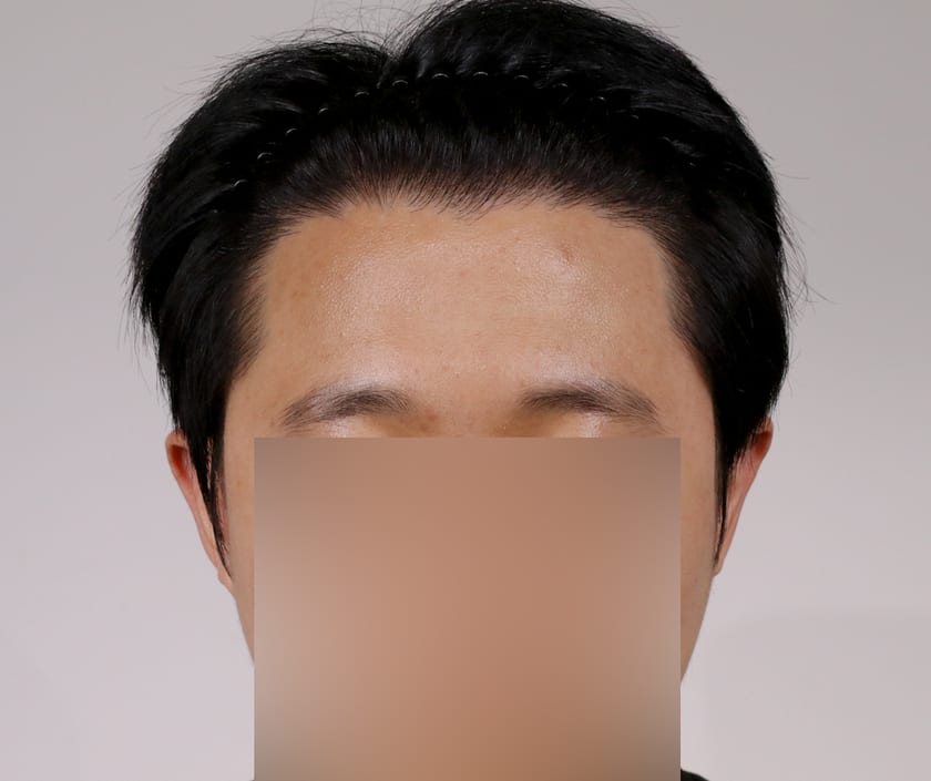 AFTER 남성 · 절개 2,500모 · 헤어라인 · 관자놀이