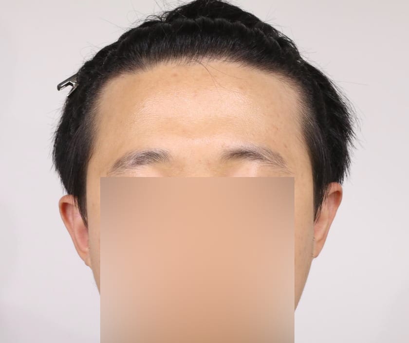 BEFORE 남성 · 절개 2,500모 · 헤어라인 · 관자놀이