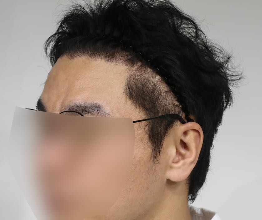 AFTER 남성 · 절개 2,500모 · 헤어라인 · 관자놀이