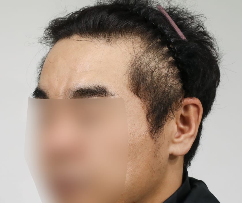 BEFORE 남성 · 절개 2,500모 · 헤어라인 · 관자놀이