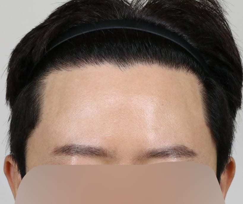 AFTER 남성 · 절개 2,800모 · 헤어라인 · 관자놀이