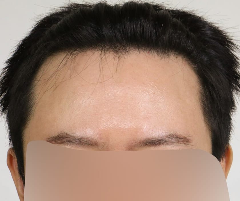 BEFORE 남성 · 절개 2,800모 · 헤어라인 · 관자놀이
