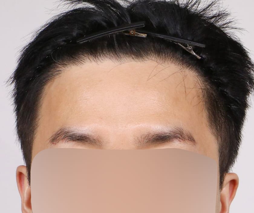 AFTER 남성 · 절개 2,900모 · 헤어라인