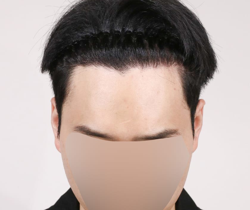 AFTER 남성 · 비절개 3,000모 · 헤어라인