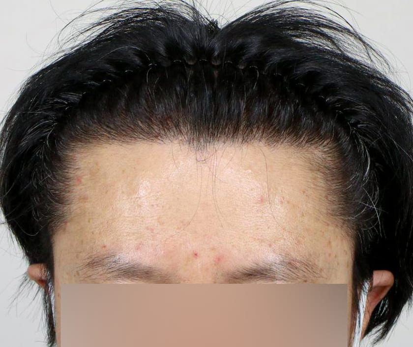 AFTER 남성 · 절개 3,000모 · 헤어라인