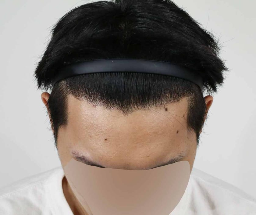 AFTER 남성 · 절개 3,000모 · 헤어라인