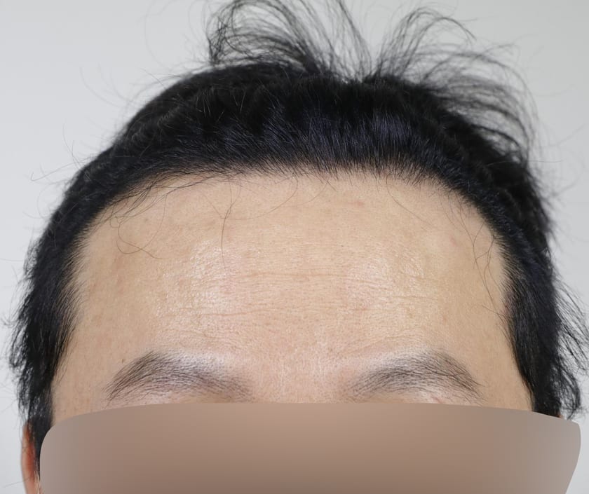 BEFORE 남성 · 절개 3,200모 · 헤어라인 · 관자놀이