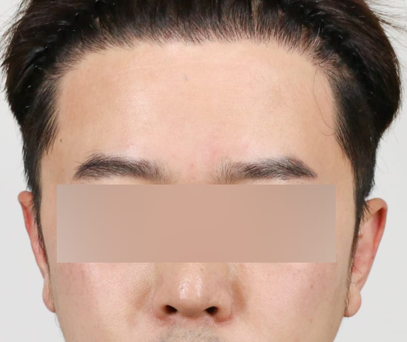 AFTER 남성 · 절개 3,200모 · 헤어라인 · 관자놀이