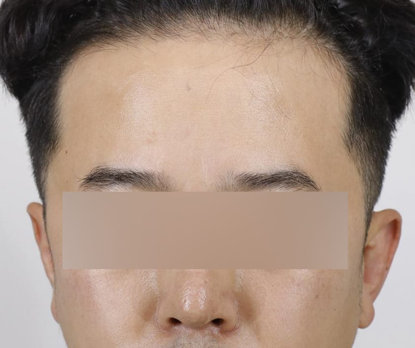 BEFORE 남성 · 절개 3,200모 · 헤어라인 · 관자놀이