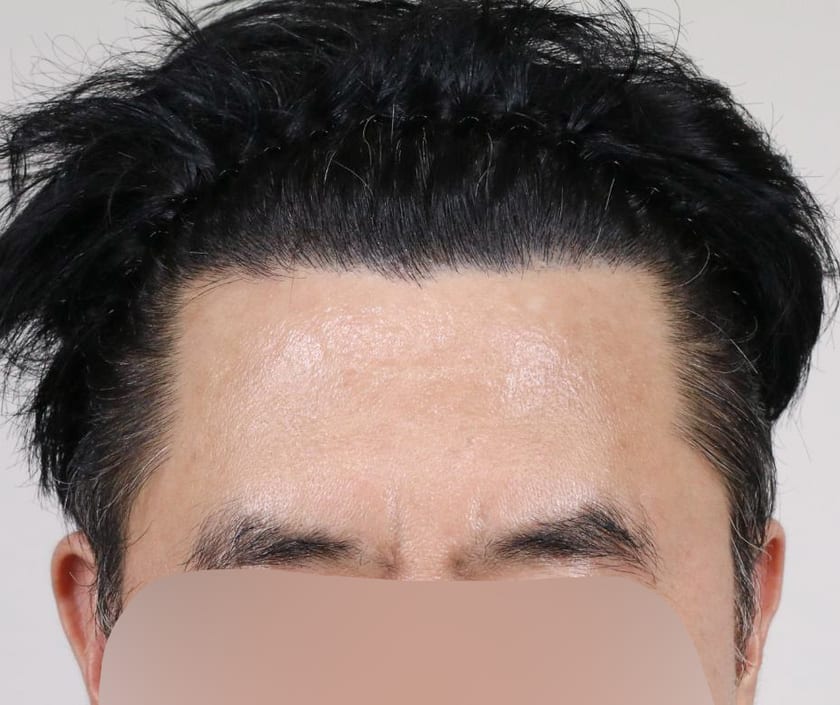 AFTER 남성 · 절개 3,300모 · 헤어라인